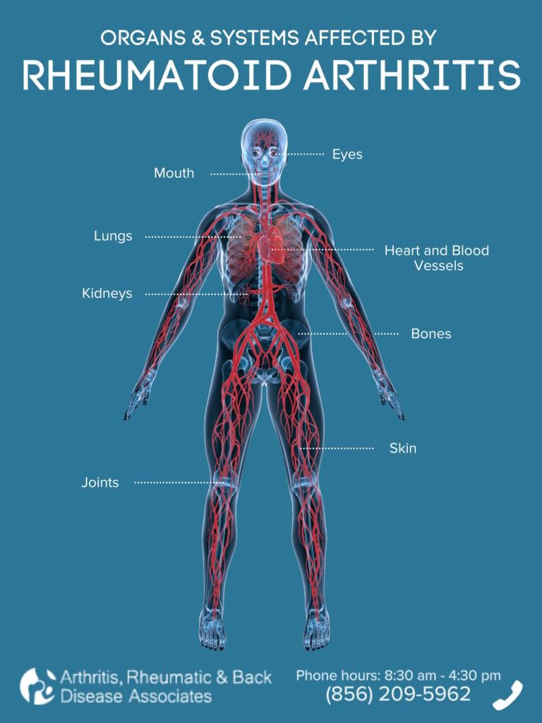 Residual Symptoms in Patients with Rheumatoid Arthritis