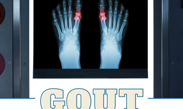 Life With Gout: Here's Everything You Need to Know