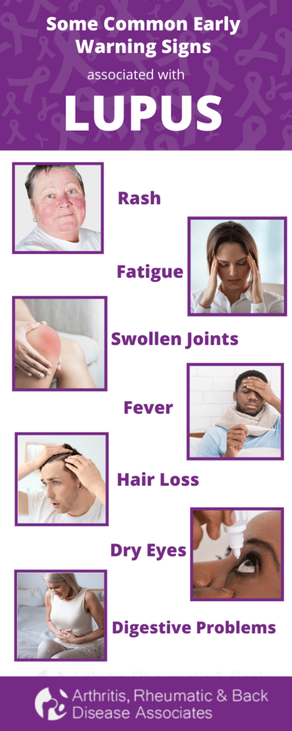 Tips for Living With Lupus & How ARBDA Can Help